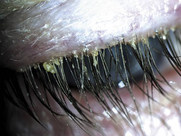 demodex mites