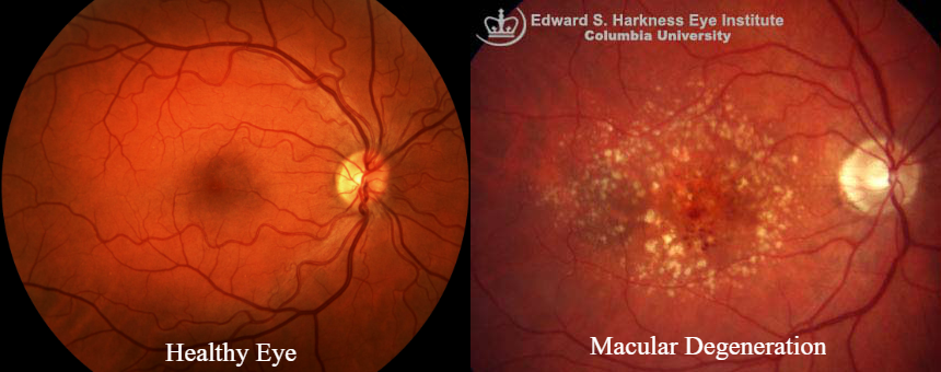 macula comparison